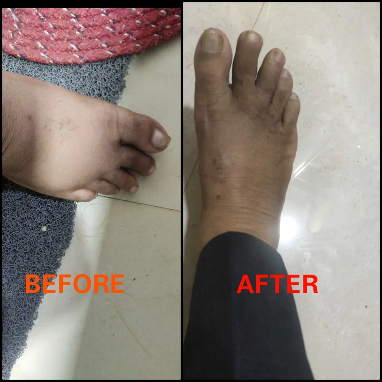 Before and after photos: swelling of the foot