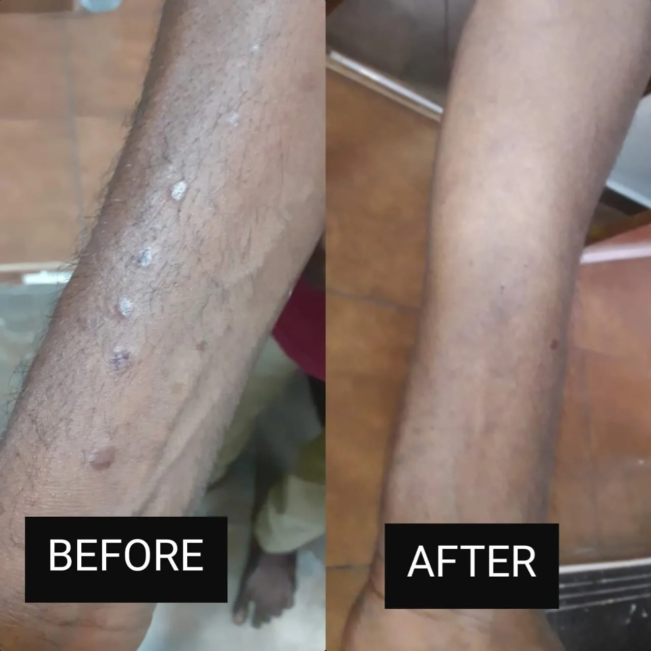 Before and after photos: skin lesions on the arm