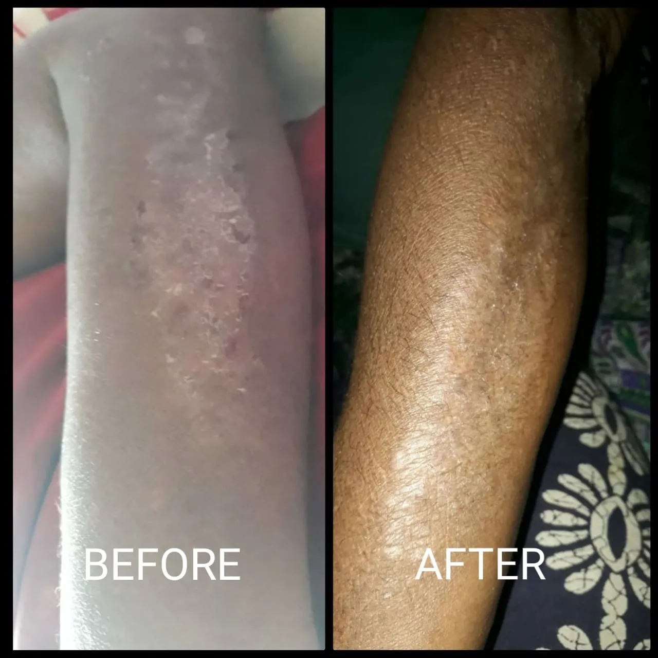Before and after photos: skin patches on the leg
