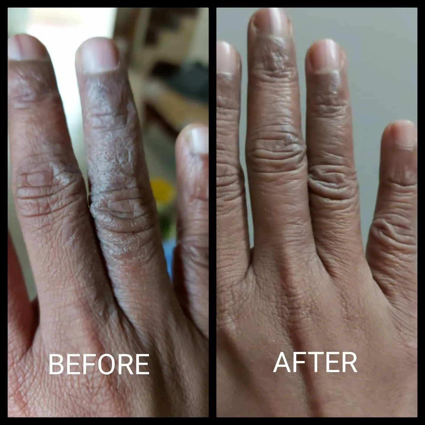 Before and after photos: dark patches on the fingers