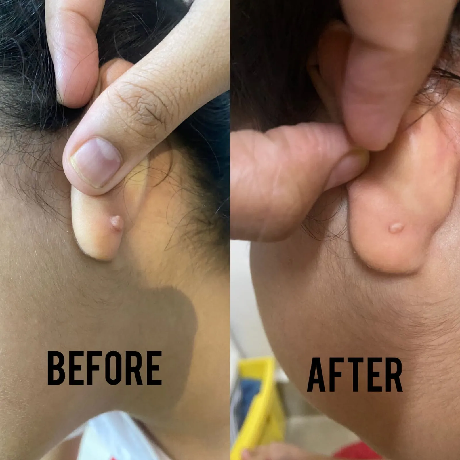 Before and after photos: skin growths behind the ear