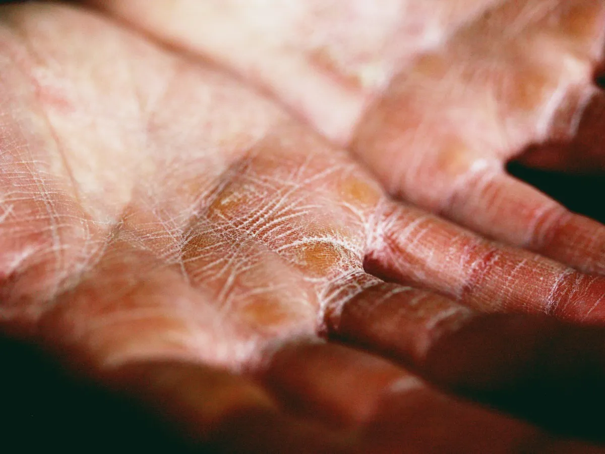 Close-up of a palm with dry, cracked and peeling skin